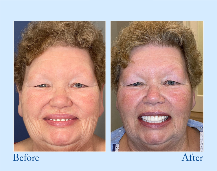 Smileasego™ - Premium Denture