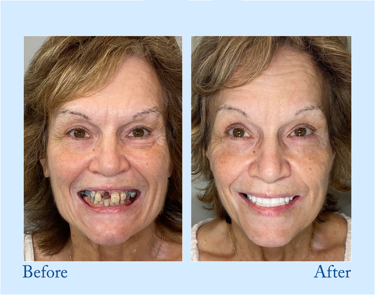 Premium Denture